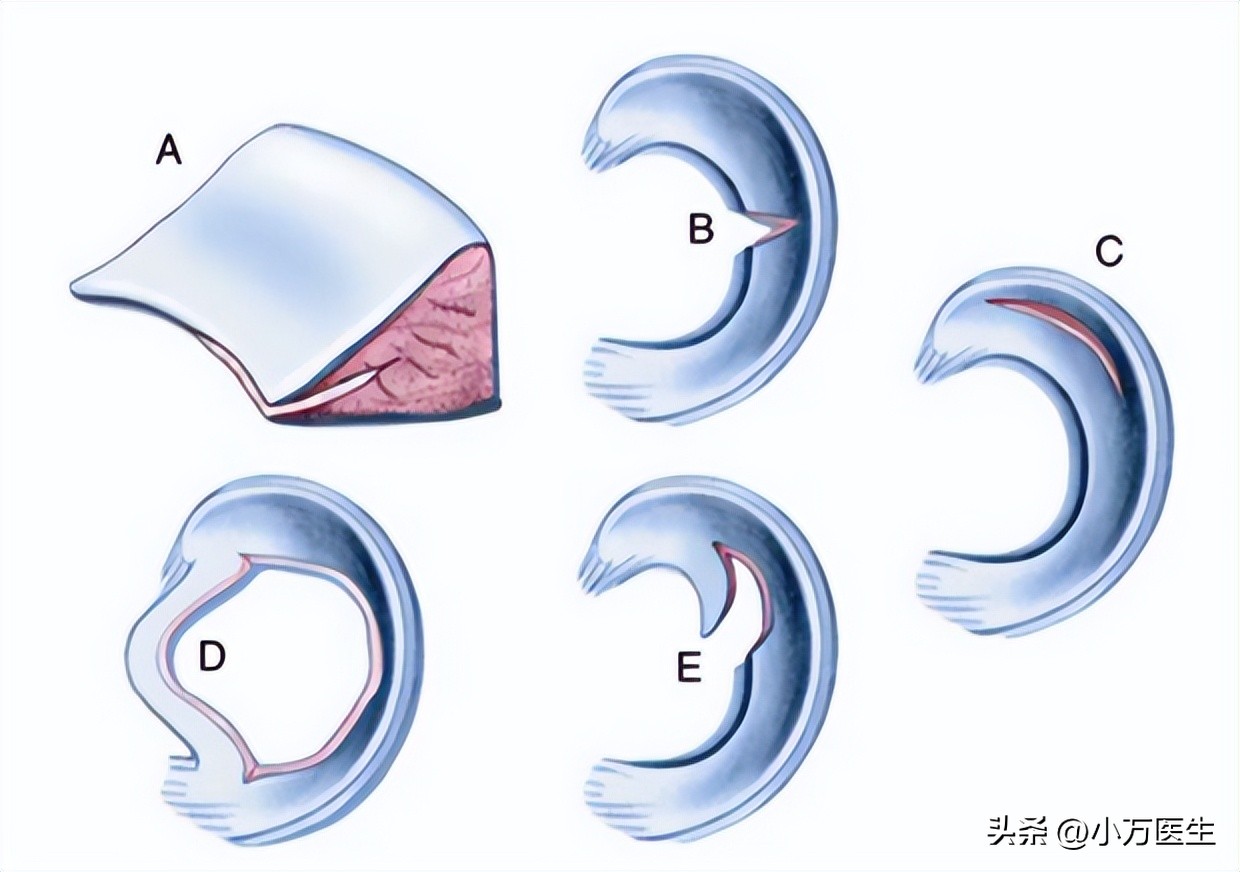 半月板后角撕裂微创手术,半月板撕裂分型
