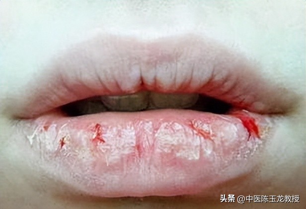 喉咙有痰什么中药泡茶喝有效,喉咙有痰有时咳嗽中药调理