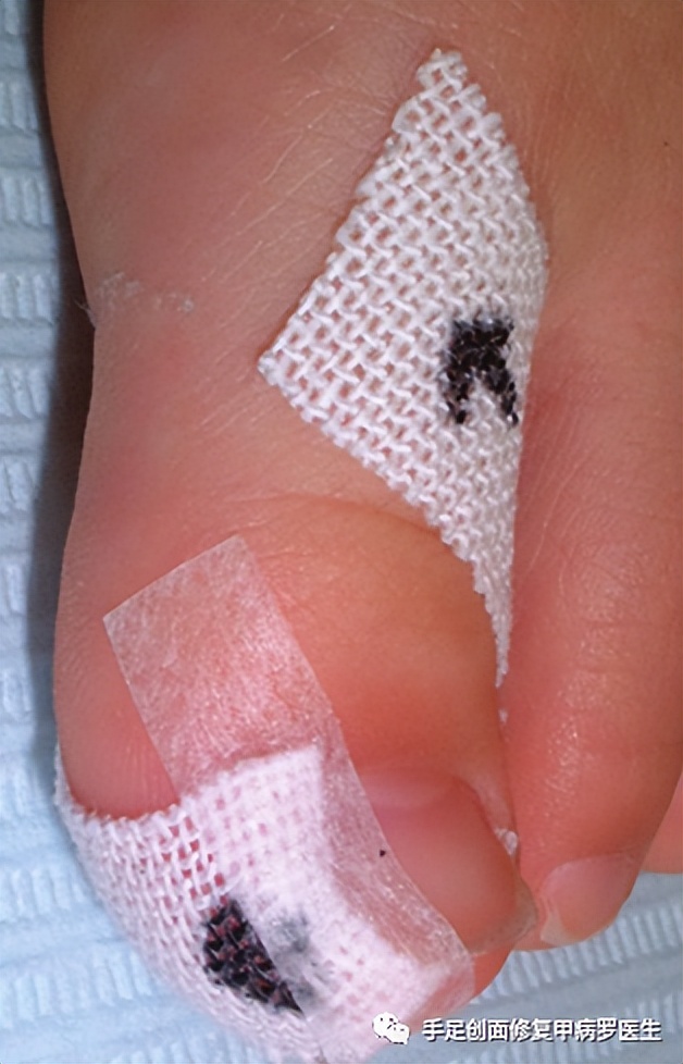 宝宝脚趾甲有脓了怎么处理,给宝宝剪指甲流脓怎么办