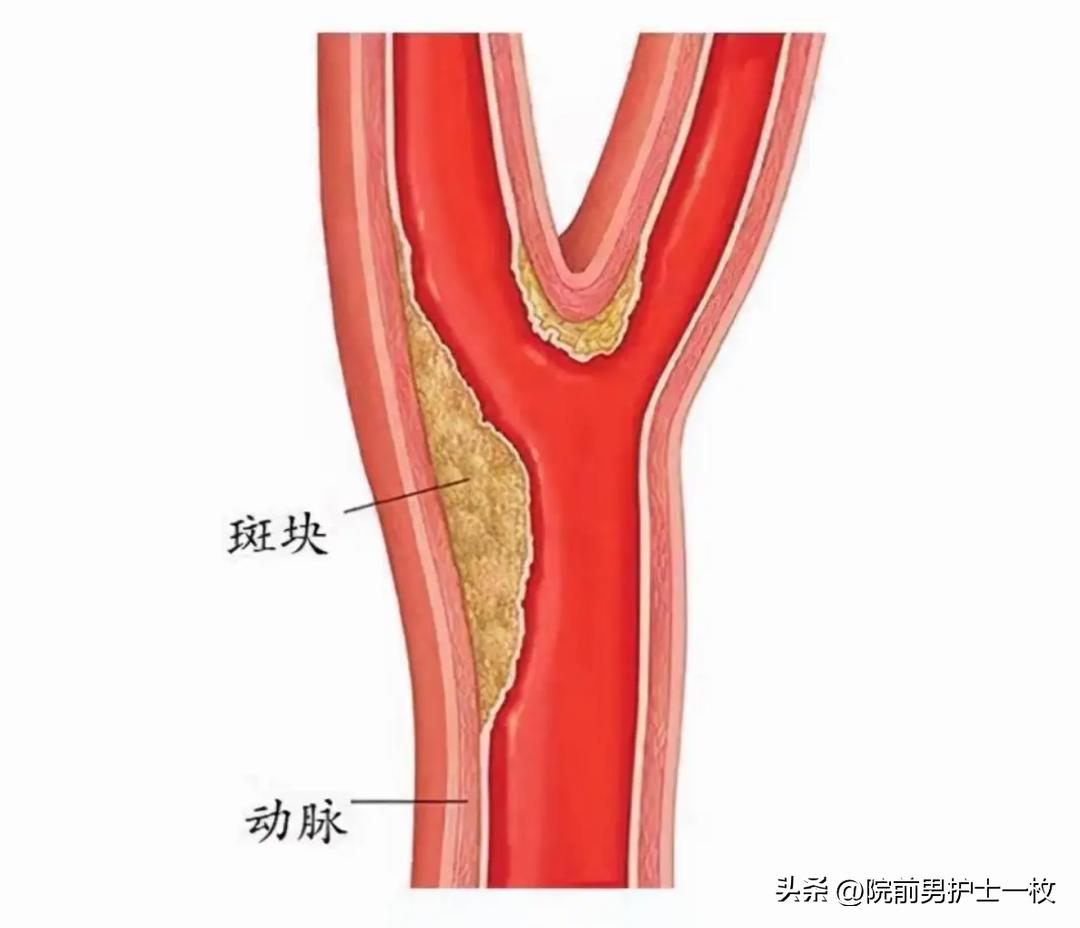 颈动脉斑块的相关知识,颈动脉斑块应该注意哪些事项
