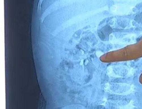 五岁儿童肾结石怎么有血尿呢,儿童12厘米肾结石