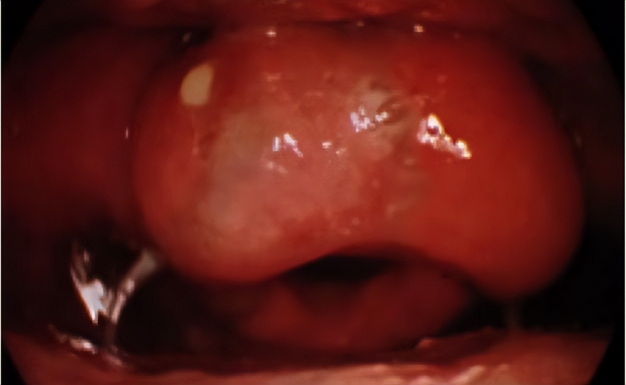 阳后喉咙痛会持续多久,半夜喉咙干疼要警惕四种疾病