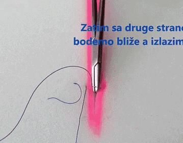 外科缝合技巧你熟练吗,外科缝合术的操作步骤