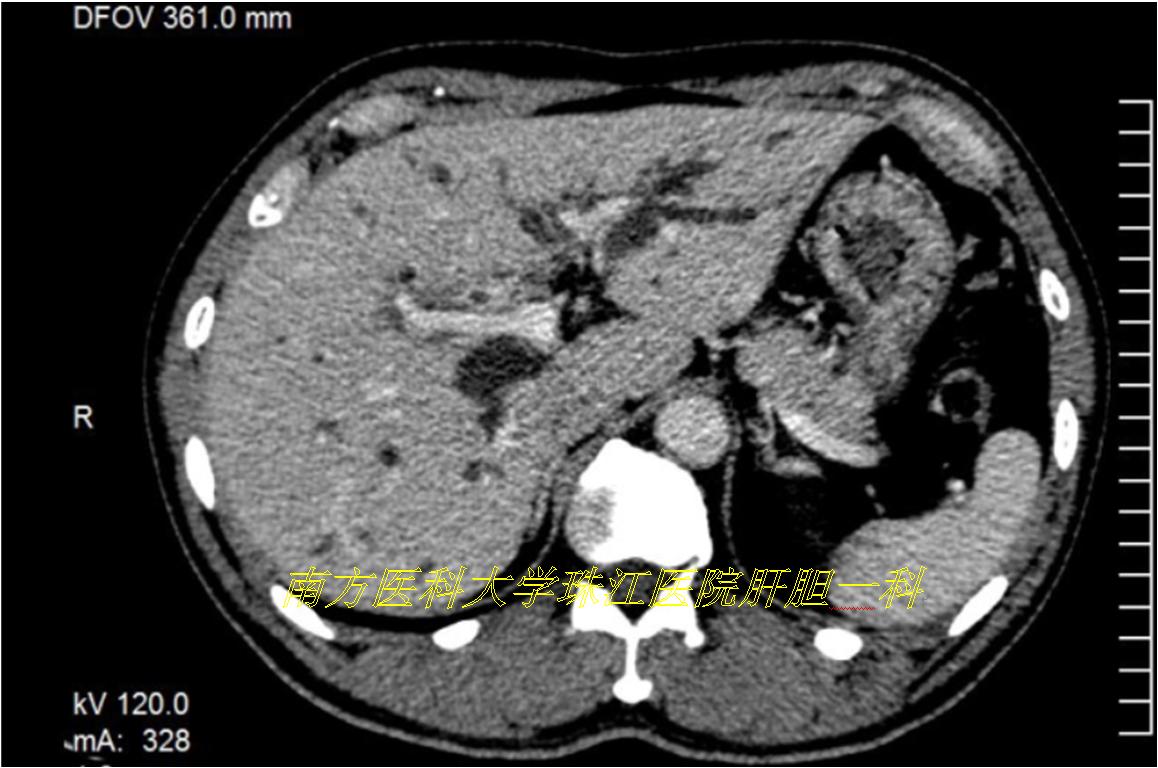 三维透视眼,透视眼治疗肿瘤