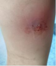 小孩皮肤有个红疙瘩里边有点硬块,小朋友皮肤上长疙瘩有白色脓包