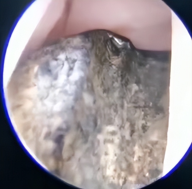 家长要小心儿童鼻腔异物,家长注意幼儿口袋里物品