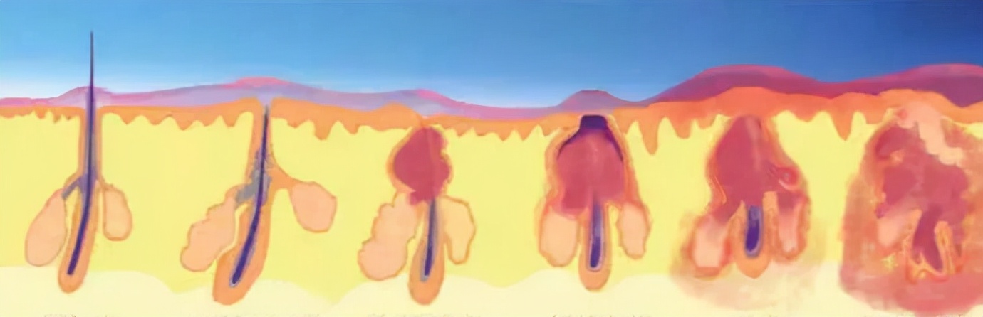 战胜痘痘重拾自信,对抗痘痘常用药膏