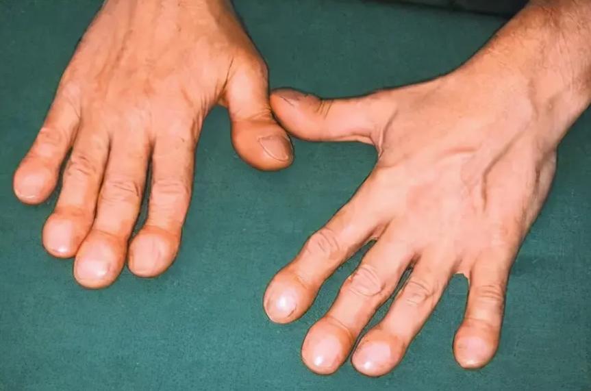 张仲景治颈椎病特效偏方视频,张仲景外敷颈椎病方子大全