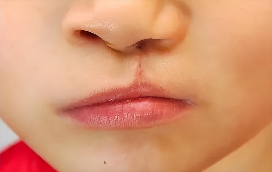 婴儿唇腭裂怎么护理,唇腭裂麻醉