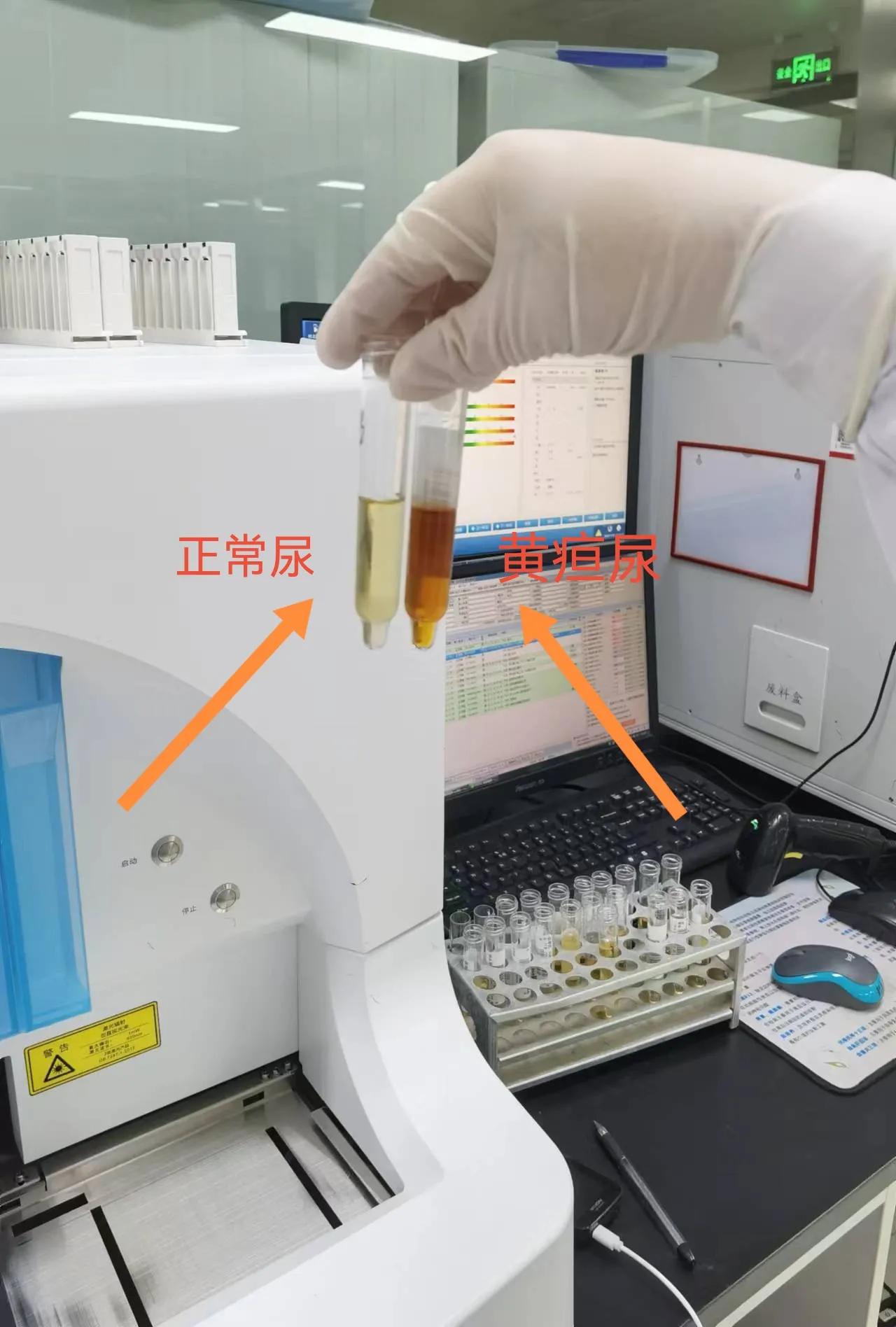 上火会导致尿液发黄吗,小便发黄是体内有火吗