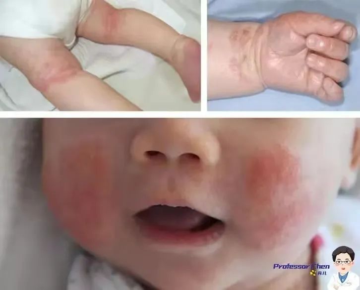 春季儿童皮肤过敏擦什么药,春季脸过敏发痒发红用什么护肤品