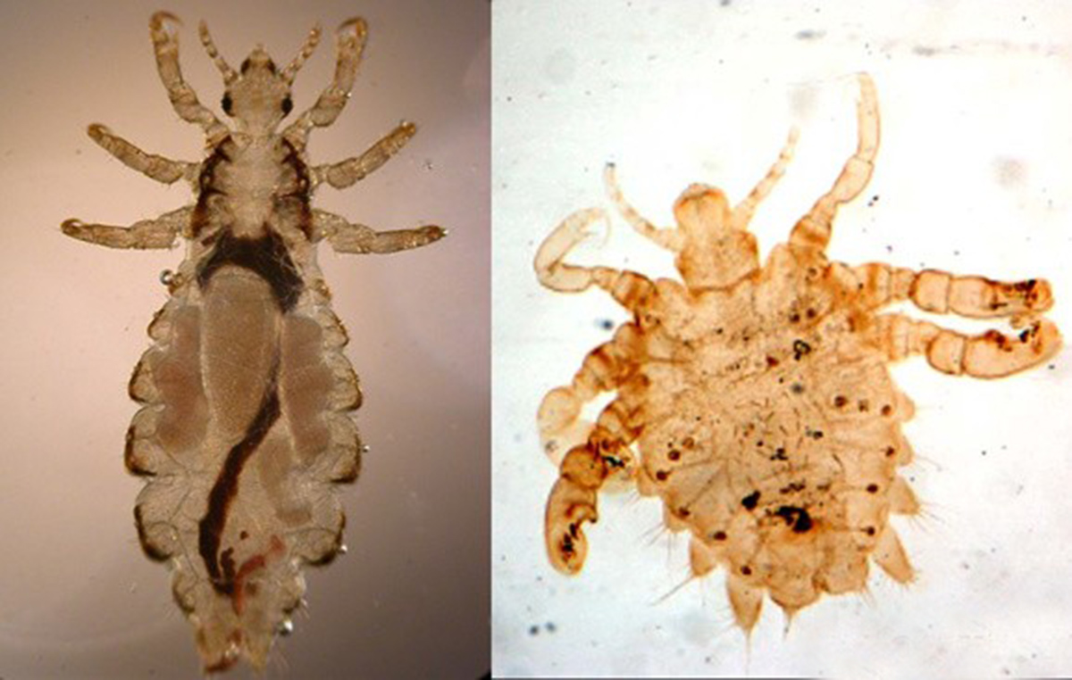 虱子在头上有什么危害,虱子对人体有哪些害处