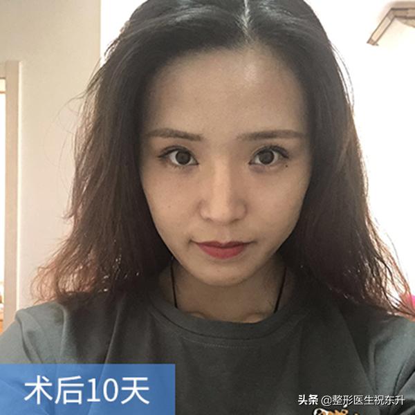 脸部脂肪填充怎样才有立体感,面部脂肪填充后会变的更幼态