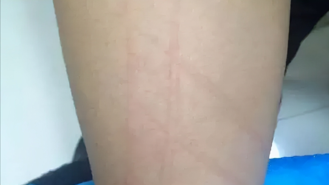 荨麻疹痒痒怎么回事,麻疹痒痒怎么办