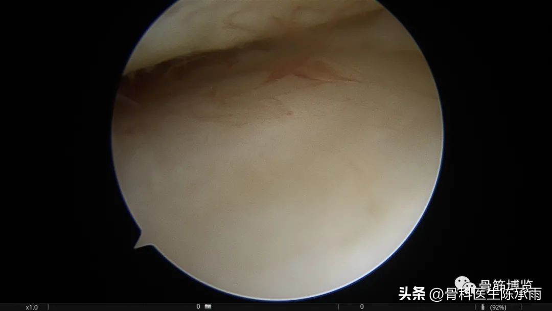 腘窝囊肿关节镜下切除复发,膝关节镜下腘窝囊肿切除的原理