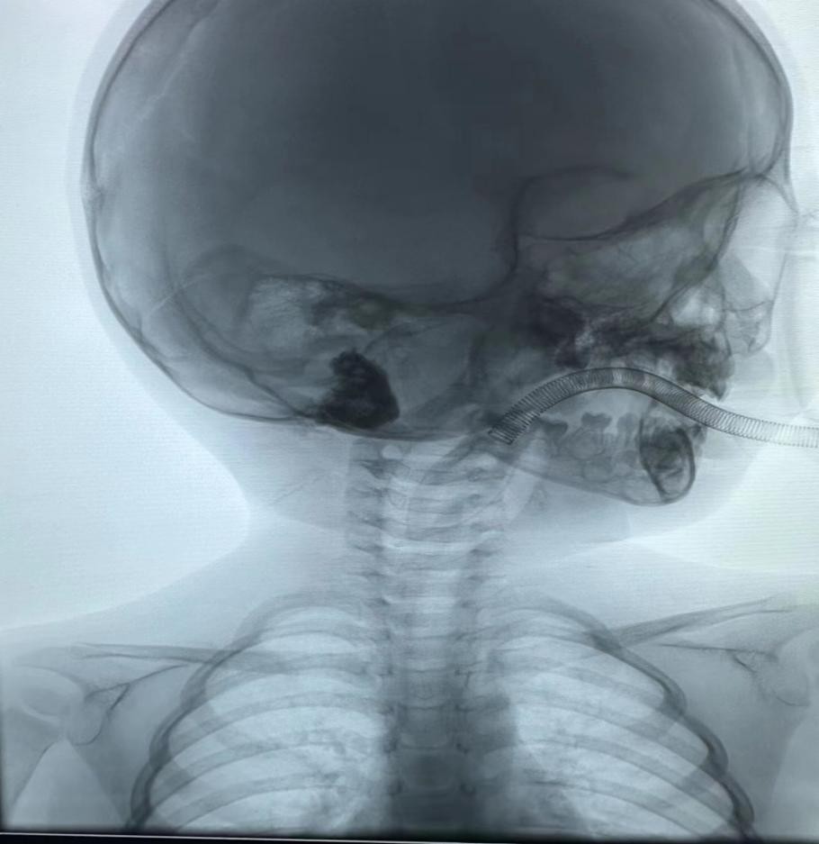 2岁男孩右侧耳后部淋巴管瘤介入治疗