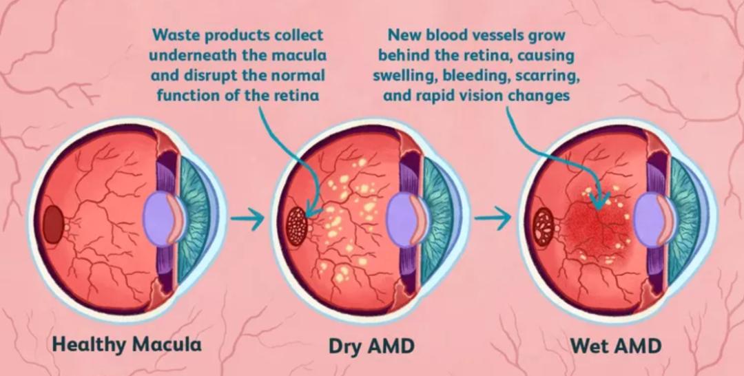 从罗氏眼科双抗收入暴涨，看VEGF眼科用药新进展
