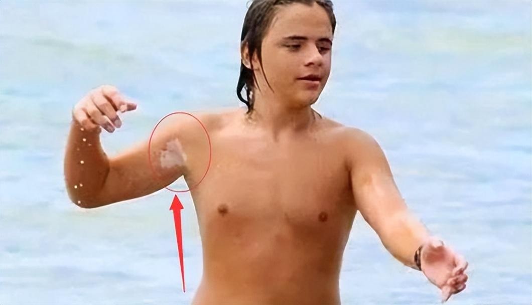 迈克尔杰克逊长子遗传病,杰克逊去世录像