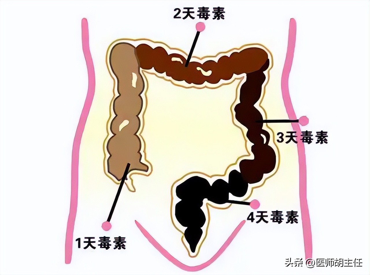 为什么肠道会长息肉,为什么肠道容易长息肉