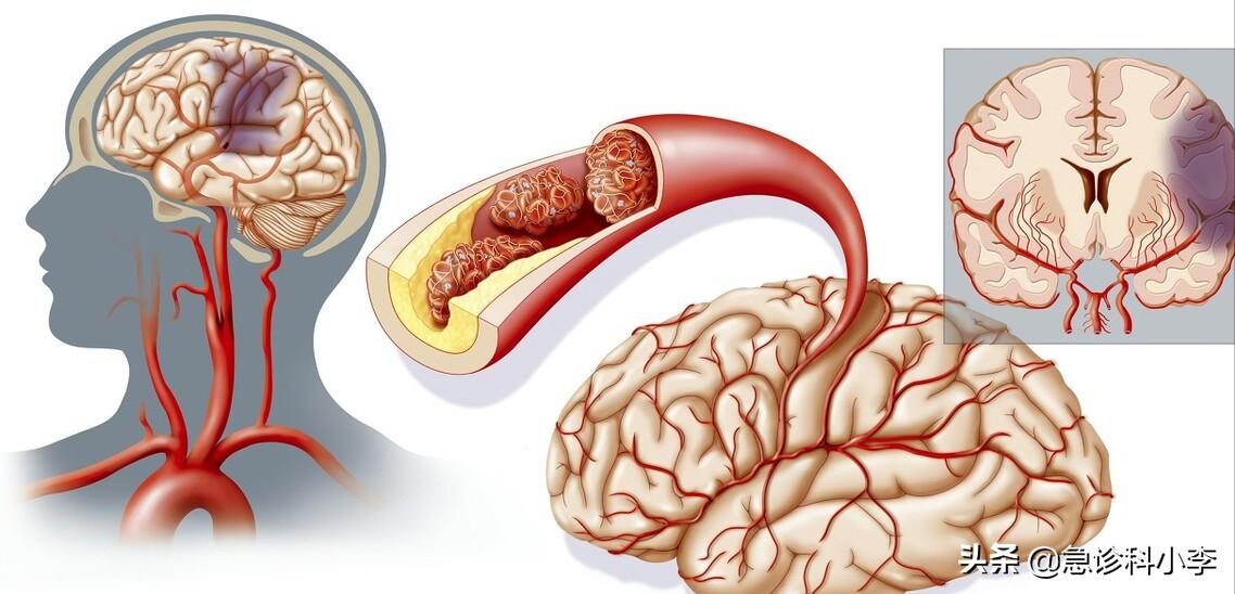 脑梗来临前腿脚先知,睡觉时出现5种迹象警惕脑梗信号