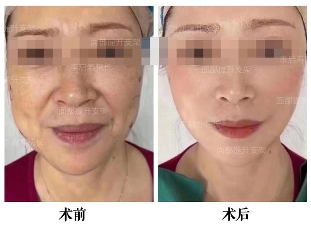 为什么随着年龄脸越来越大,为什么随着年龄的增长脸越来越宽