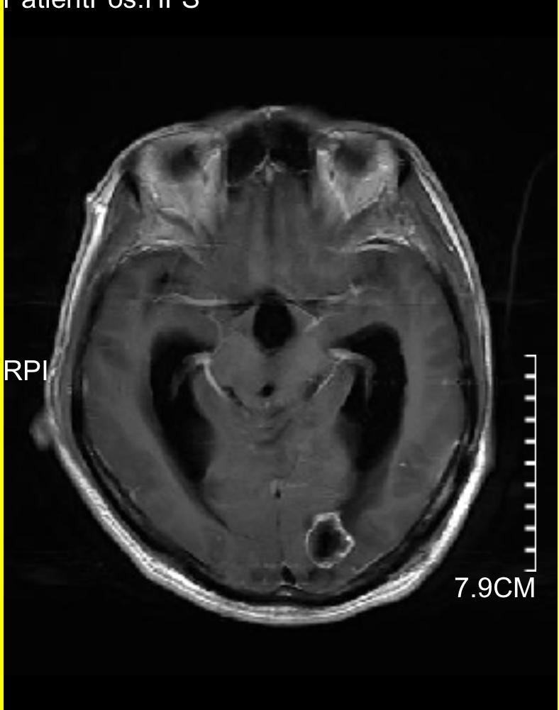 发现脑肿瘤怎么办,发现脑卒中前兆怎么办