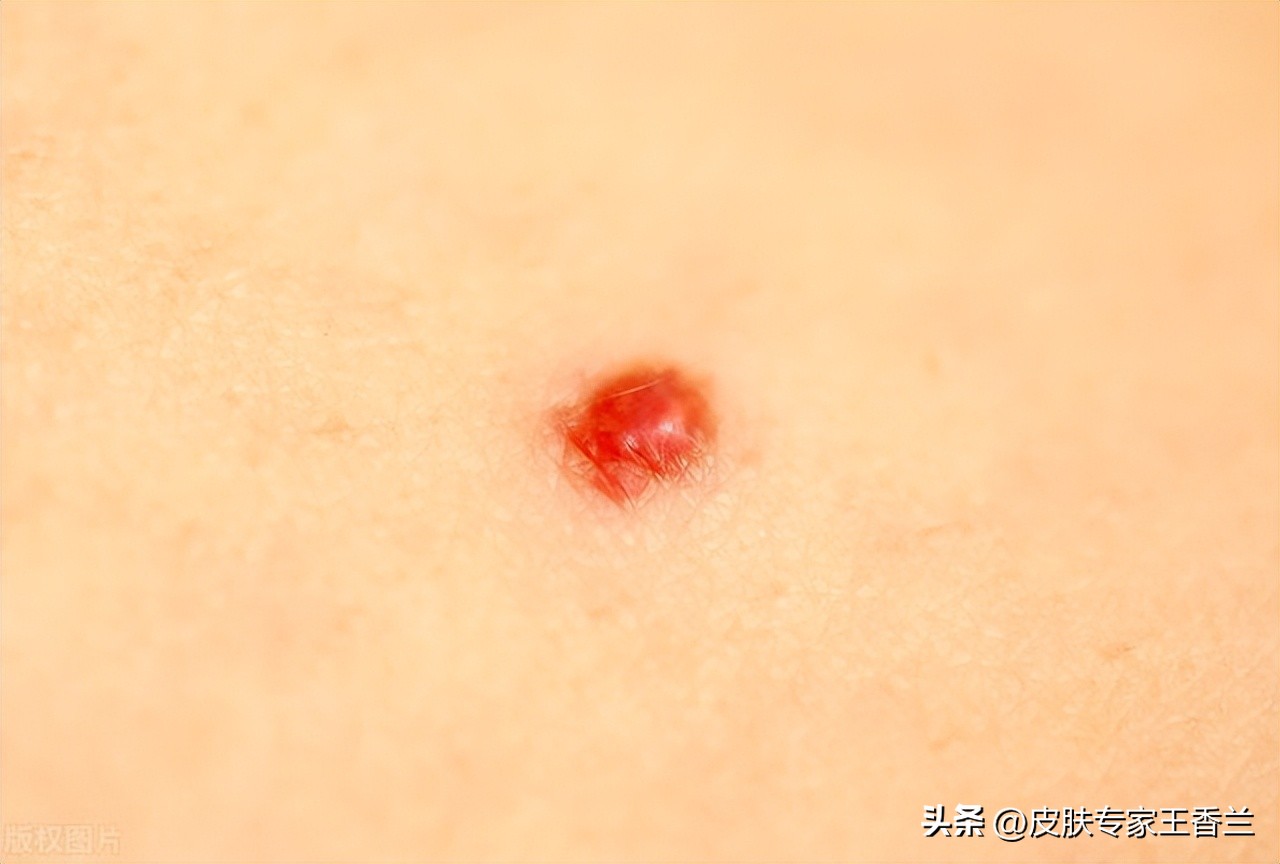 湿疹治标不治本怎么办,湿疹治不好怎么办