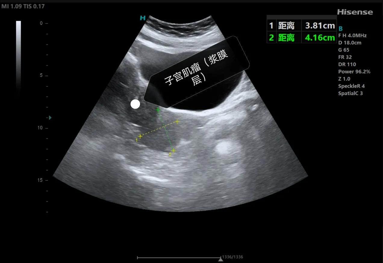 子宫肌瘤是怎么患上的,得了子宫肌瘤该如何是好