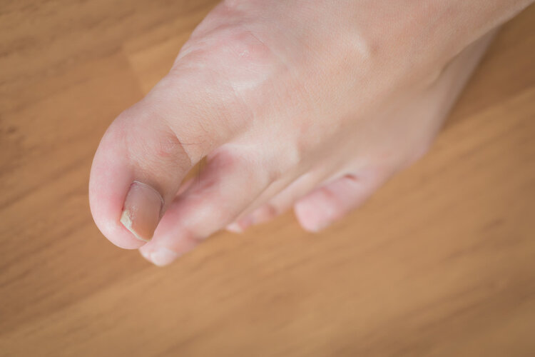 脚趾甲老往肉里长是缺什么吗,脚趾甲长到肉里一碰就疼如何解决
