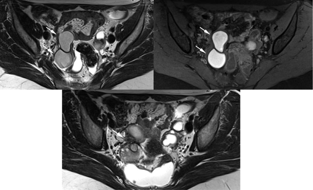 MRI如何评估子宫内膜异位症？这10个病例会帮助您