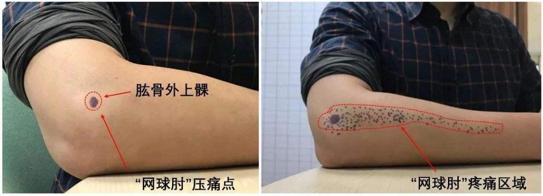 手一握胳膊肘关节疼痛怎么回事,胳膊肘关节疼痛如何缓解