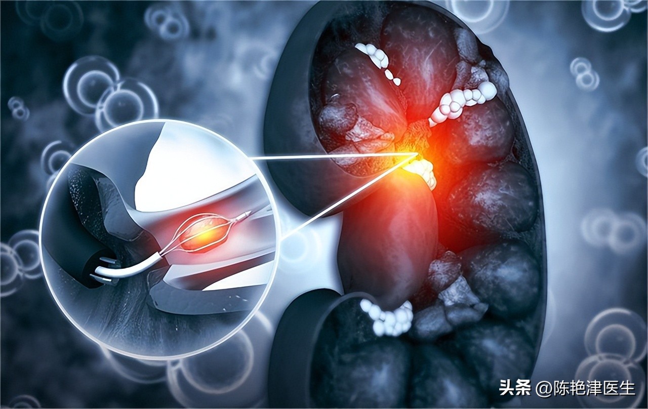 体检查出有肾结石要注意什么,体检有肾结石应该怎么处理