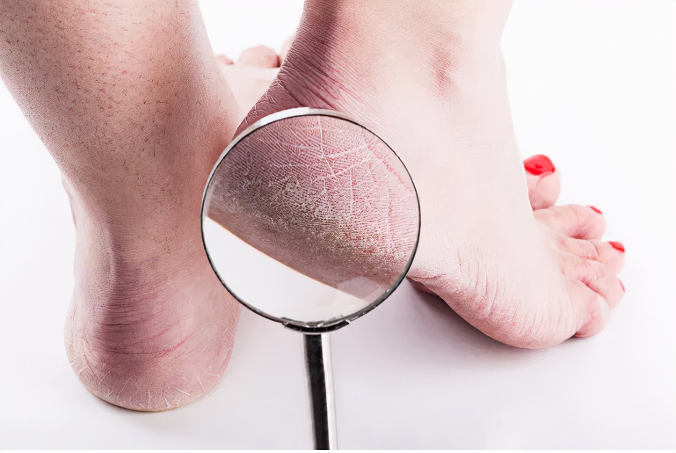 为什么有些人的脚后跟总开裂，可能是4种原因导致，附解决方法