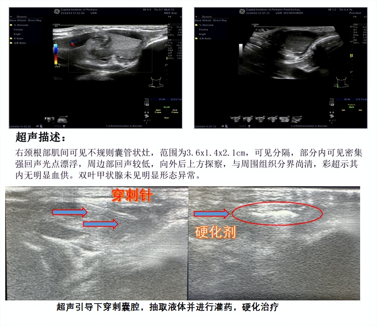 儿童腹部淋巴管瘤微创多久能下床,婴儿颈后淋巴管瘤介入治疗