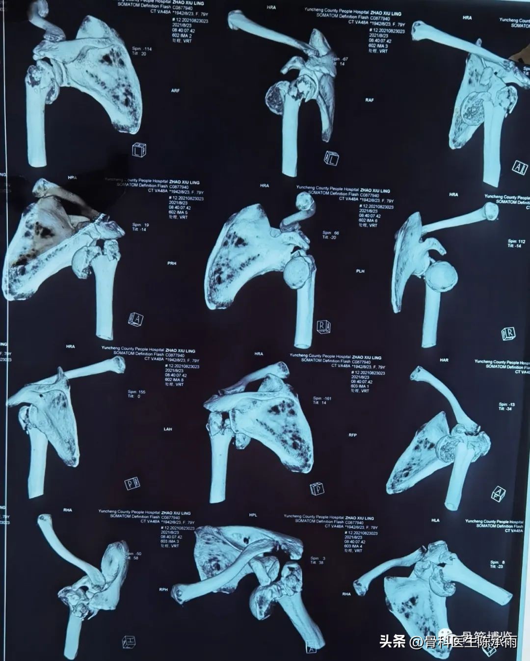 右肱骨外科颈骨折康复视频,肱骨颈骨折后并发症有哪些