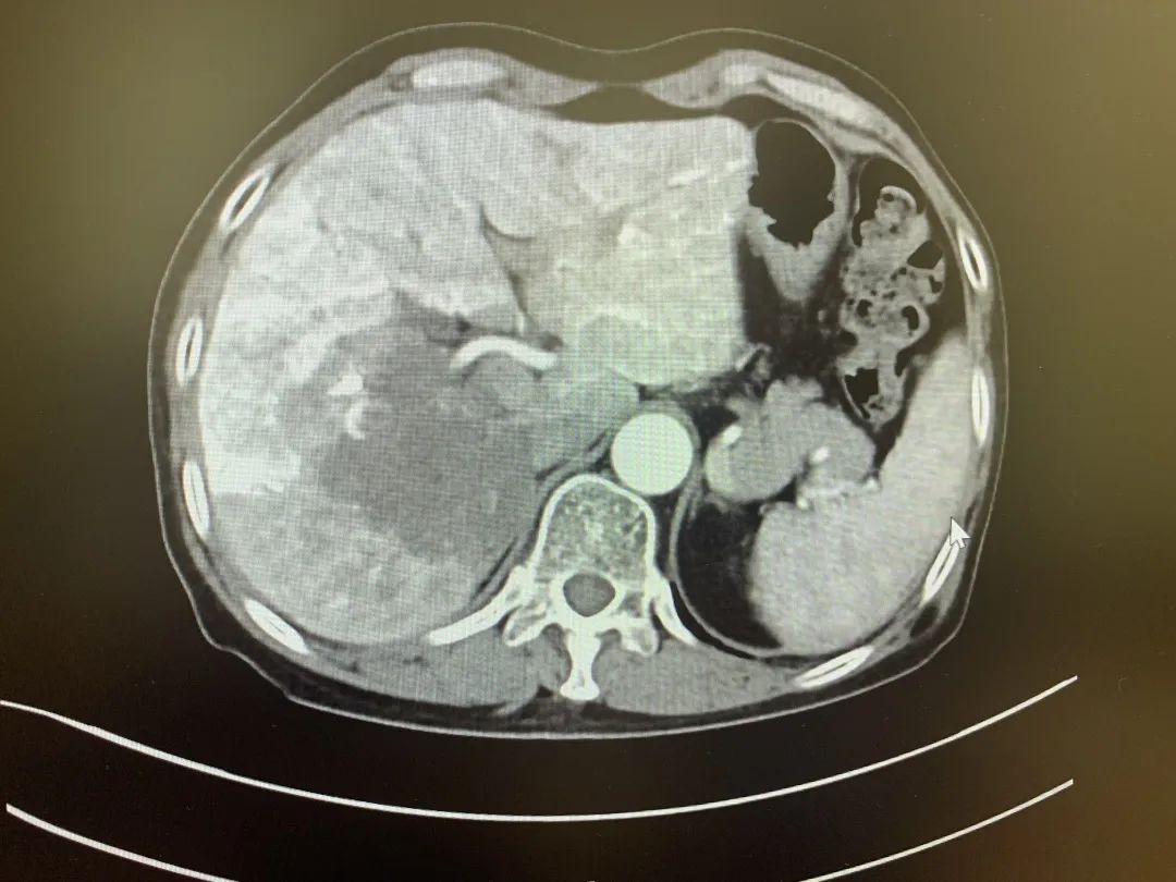 肝癌治疗出现奇迹,肝癌精准治疗