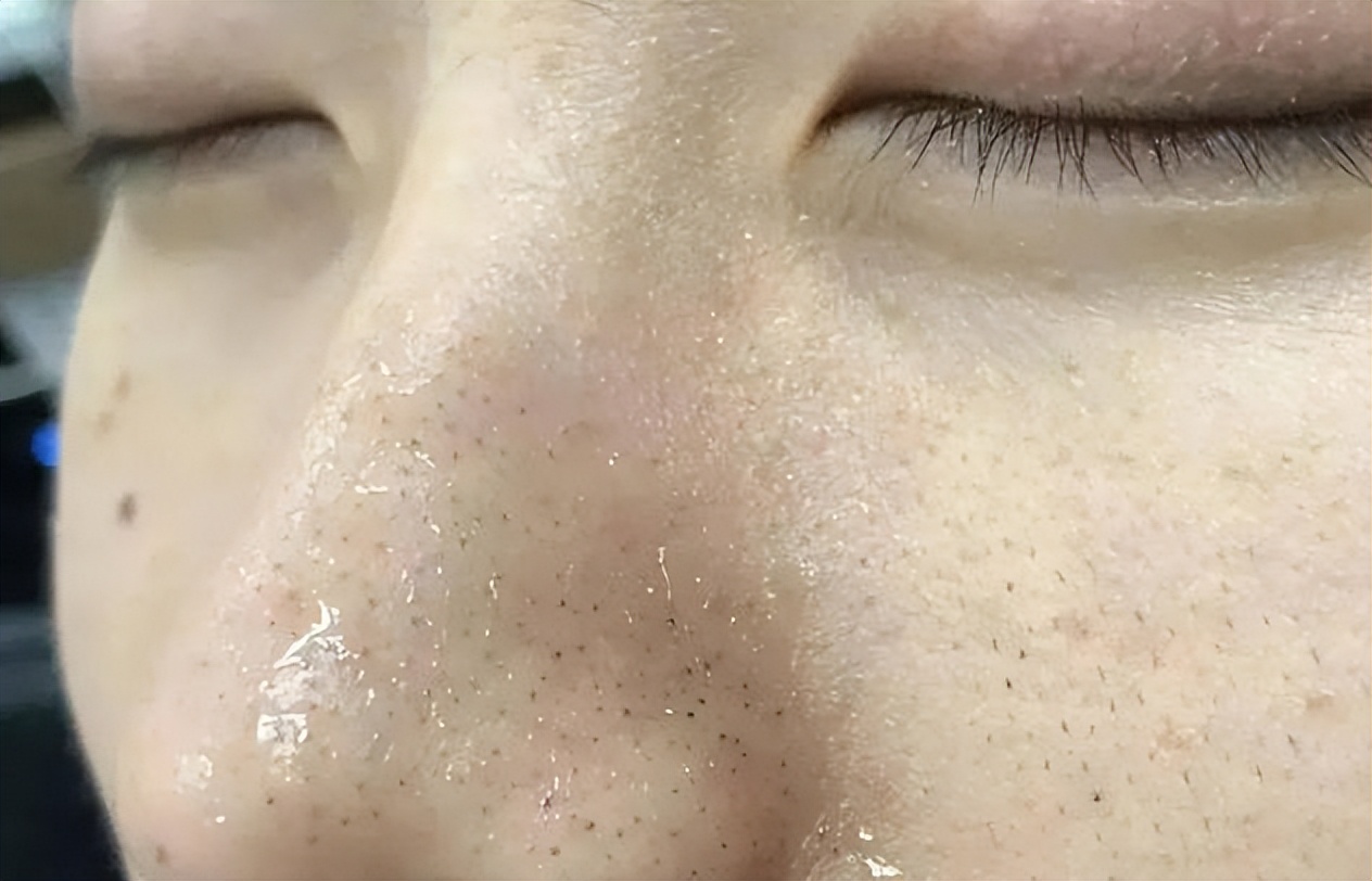 鼻子上挤出白色的是螨虫吗,怎么知道鼻子是螨虫引起的红血丝