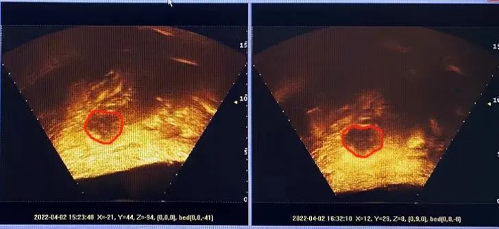 「诊疗我们更专业——技术篇」“强强联合隔山打牛”创首例