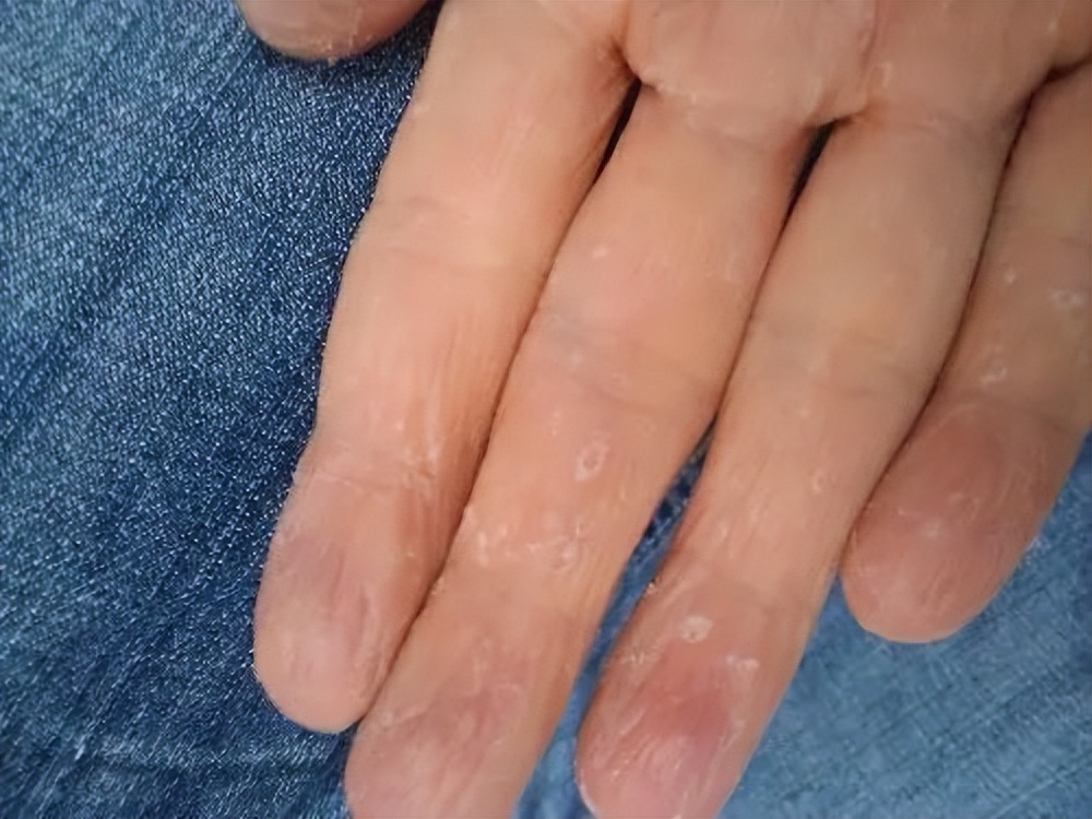 手部脱皮有没有快速治疗方法,手部脱皮严重是什么原因