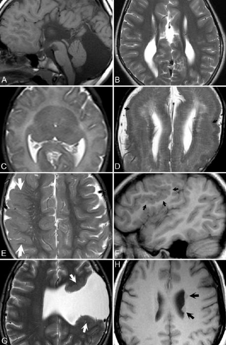 先天性脑血管畸形的核磁共振图片,脑裂畸形的ct报告