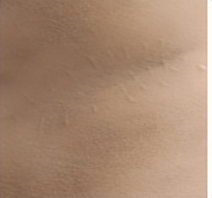 最难愈合的疤痕,无法治愈的疤痕