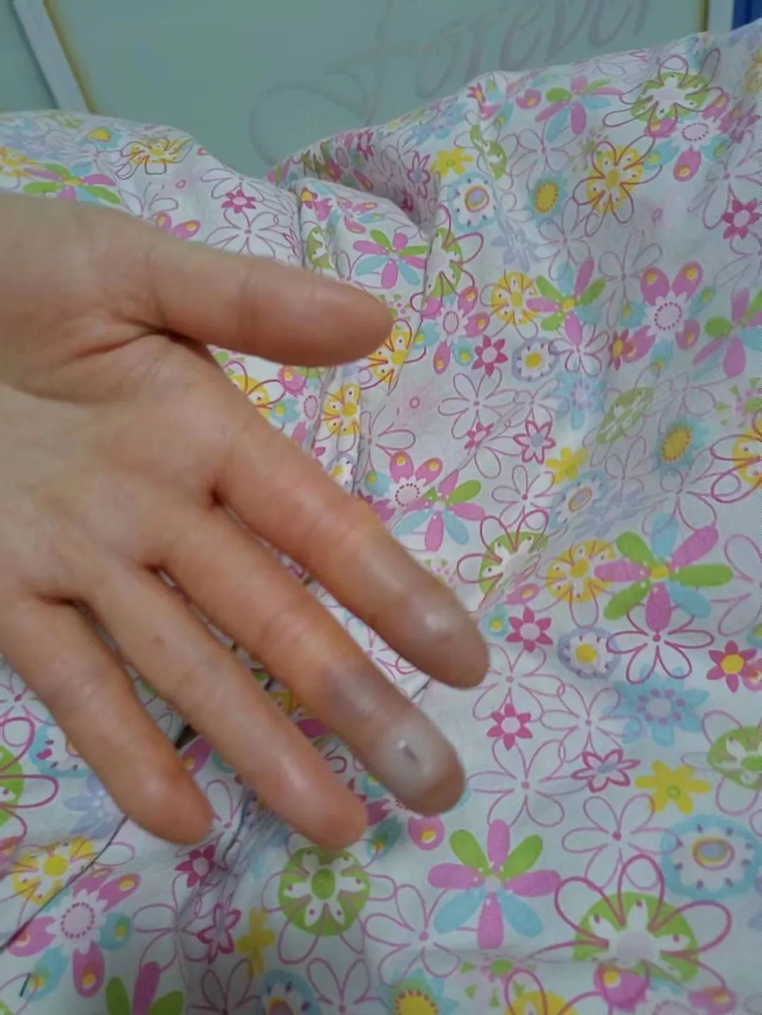 护士冻伤手怎么处理,医护手冻伤