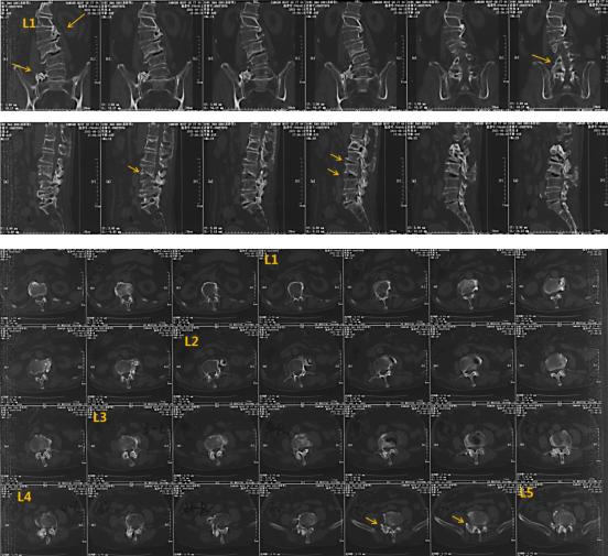 老年人脊柱侧弯的危害和症状,老人脊柱侧弯腰部疼痛怎么缓解