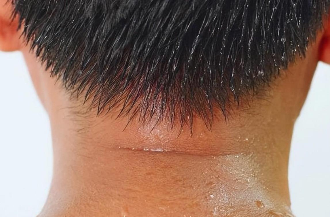 头脖子爱出汗中医认为是什么原因,头部容易出汗中医认为是什么原因