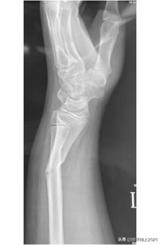 小孩被自行车撞康复要赔偿,孩子不小心被自行车撞了一下