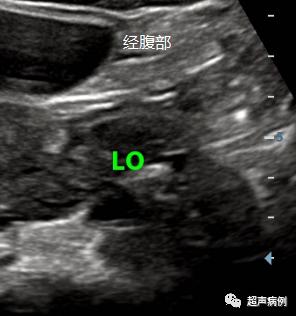 做阴道B超是一种什么样的体验?