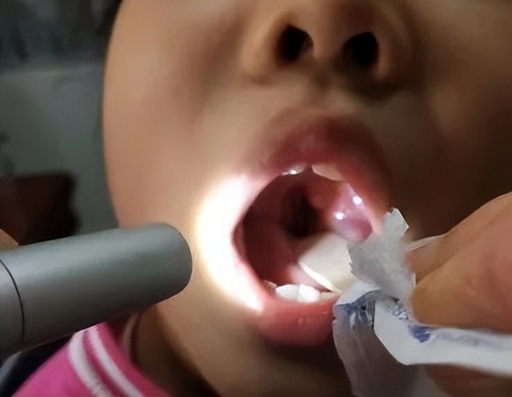 腺样体肥大的孩子手术怎么做,除了手术怎么改善孩子腺样体肥大