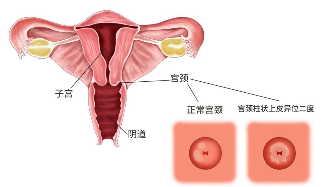 宫颈糜烂肥大囊肿会引起宫颈癌吗,六十岁宫颈糜烂中度会得宫颈癌吗