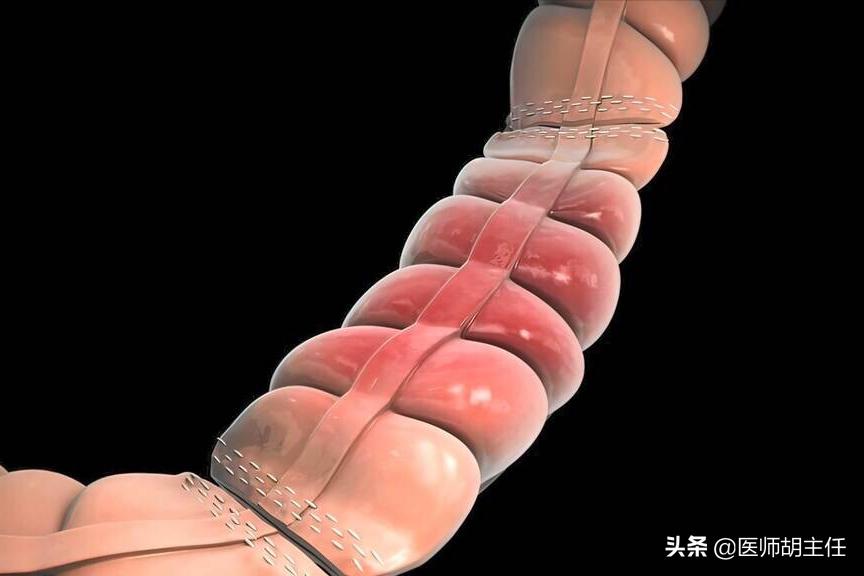 肠道有息肉会出现什么症状,肠道长了息肉有什么症状