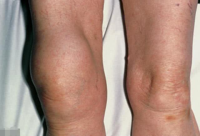 孩子现在得了滑膜炎怎么治疗,儿童得了滑膜炎怎么回事